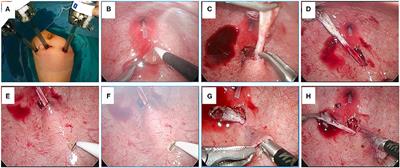 Use of Urethral Sound to Facilitate Locating Retrovesical Ureter for Politano-Leadbetter Pneumovesicoscopic Ureteral Reimplantation